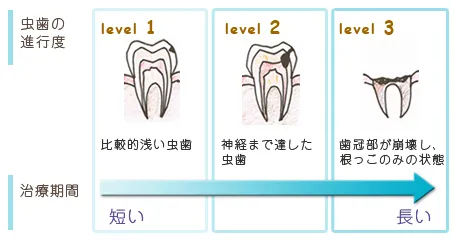 虫歯の進行度合い