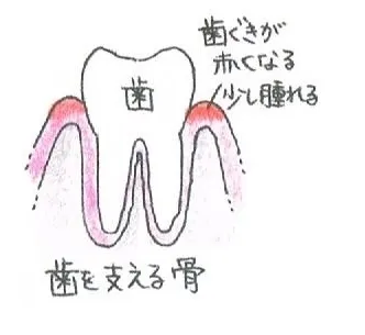 歯茎が赤くなり、少し腫れます。 歯茎が赤くなり、少し腫れます。