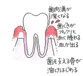 歯肉溝が深くなり、歯茎がプックリ赤く腫れて血が出ます。 歯肉溝が深くなり、歯茎がプックリ赤く腫れて血が出ます。
