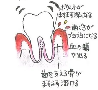 歯茎がブヨブヨになり、血や膿が出ます。硬い物が噛みづらくなります。 歯茎がブヨブヨになり、血や膿が出ます。硬い物が噛みづらくなります。