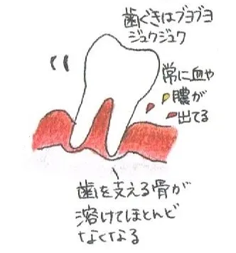 常に血や膿が出ます。痛くて物が噛めません。 常に血や膿が出ます。痛くて物が噛めません。